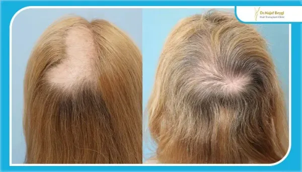  عکس های کاشت موی زنان + کاشت مو در زنان به چه صورت است