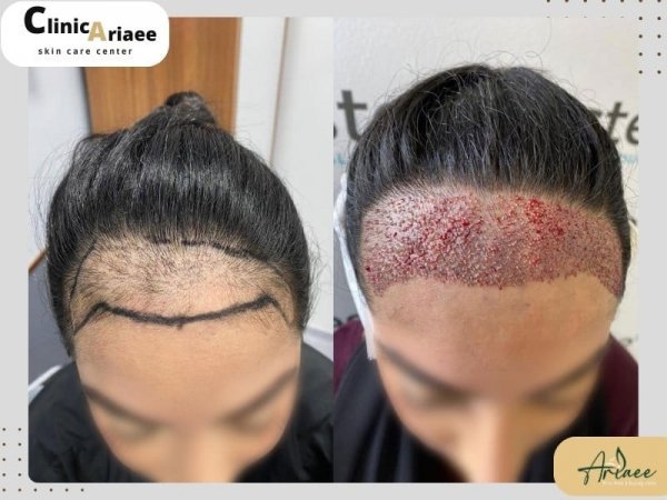  عکس های کاشت موی زنان + کاشت مو در زنان به چه صورت است