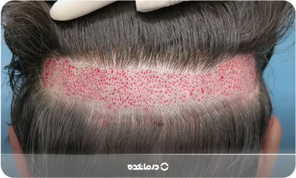  فیلم کاشت مو از بدن به سر + کاشت مو از زیر بغل