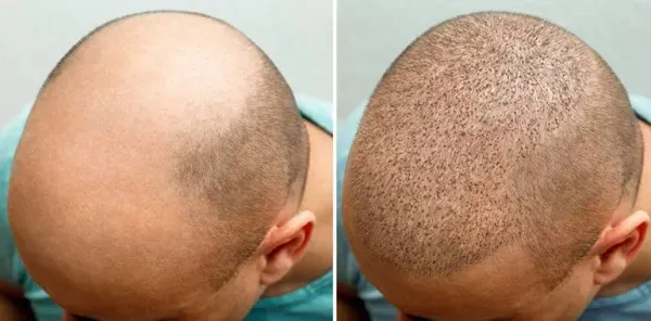  فیلم کاشت مو از بدن به سر + کاشت مو از زیر بغل