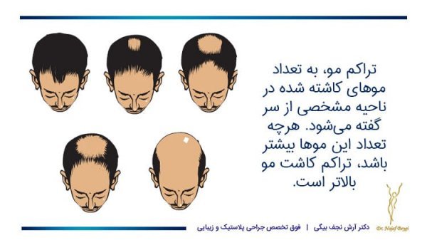  فیلم کاشت مو از بدن به سر + کاشت مو از زیر بغل