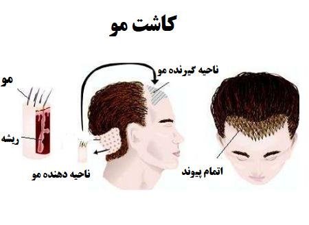  فیلم کاشت مو از بدن به سر + کاشت مو از زیر بغل