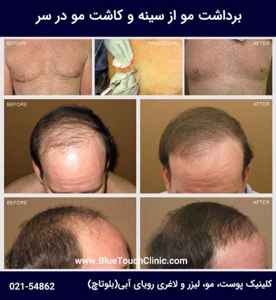  فیلم کاشت مو از بدن به سر + کاشت مو از زیر بغل