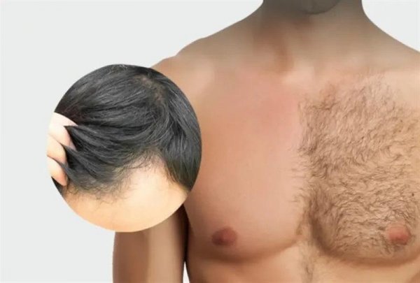  فیلم کاشت مو از بدن به سر + کاشت مو از زیر بغل