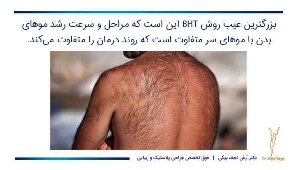  فیلم کاشت مو از بدن به سر + کاشت مو از زیر بغل