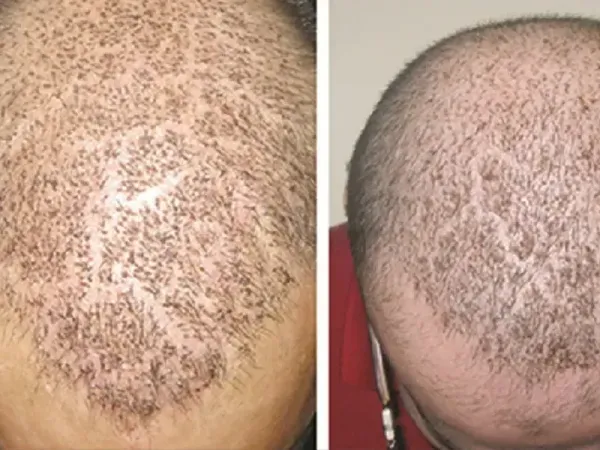  فیلم کاشت مو از بدن به سر + کاشت مو از زیر بغل