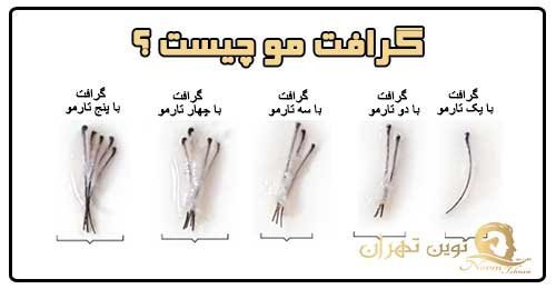  فیلم کاشت مو از بدن به سر + کاشت مو از زیر بغل