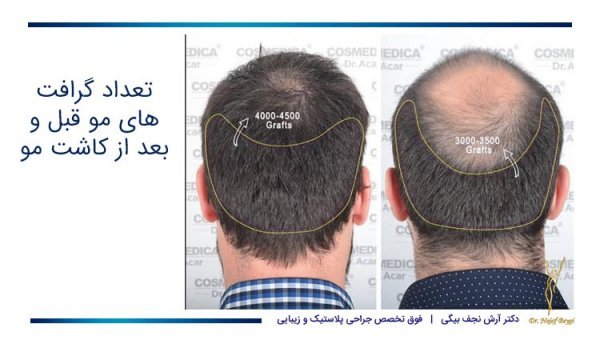  فیلم کاشت مو از بدن به سر + کاشت مو از زیر بغل