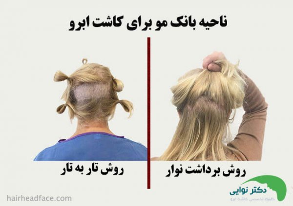 فیلم برداشت مو برای کاشت ابرو+نظرات در مورد کاشت ابرو