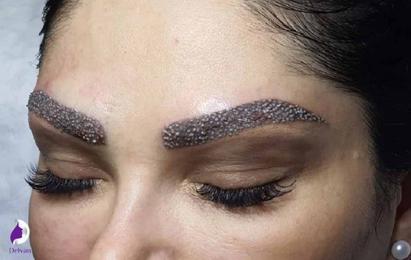  فیلم برداشت مو برای کاشت ابرو+نظرات در مورد کاشت ابرو