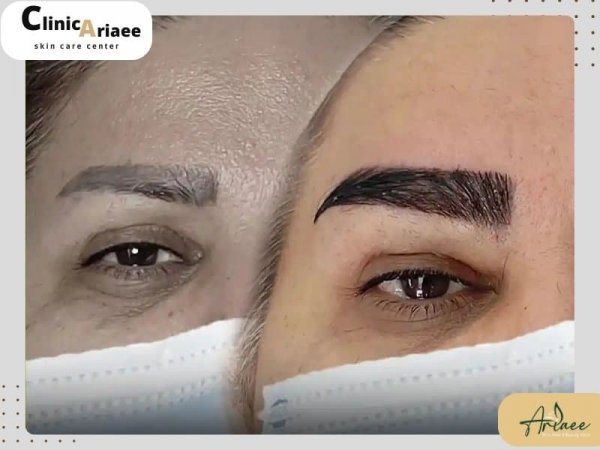  فیلم برداشت مو برای کاشت ابرو+نظرات در مورد کاشت ابرو