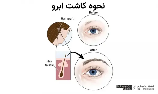  فیلم برداشت مو برای کاشت ابرو+نظرات در مورد کاشت ابرو