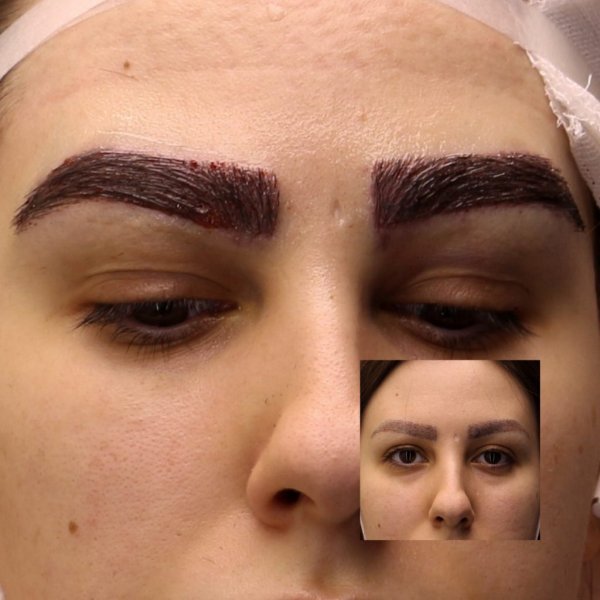  فیلم برداشت مو برای کاشت ابرو+نظرات در مورد کاشت ابرو