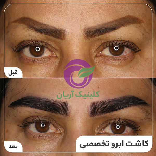  فیلم برداشت مو برای کاشت ابرو+نظرات در مورد کاشت ابرو
