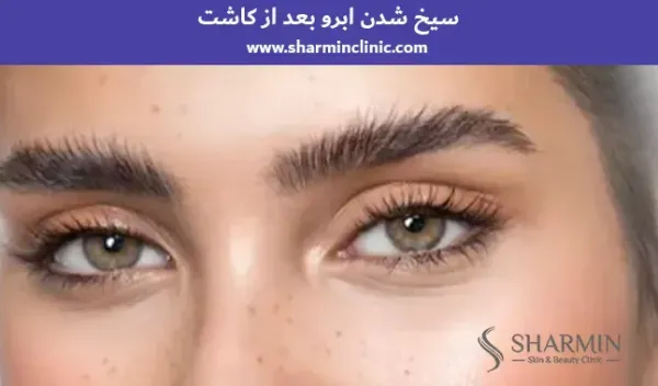  چرا بعد از کاشت ابرو نباید رابطه جنسی سکس داشت