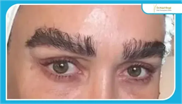  چرا بعد از کاشت ابرو نباید رابطه جنسی سکس داشت