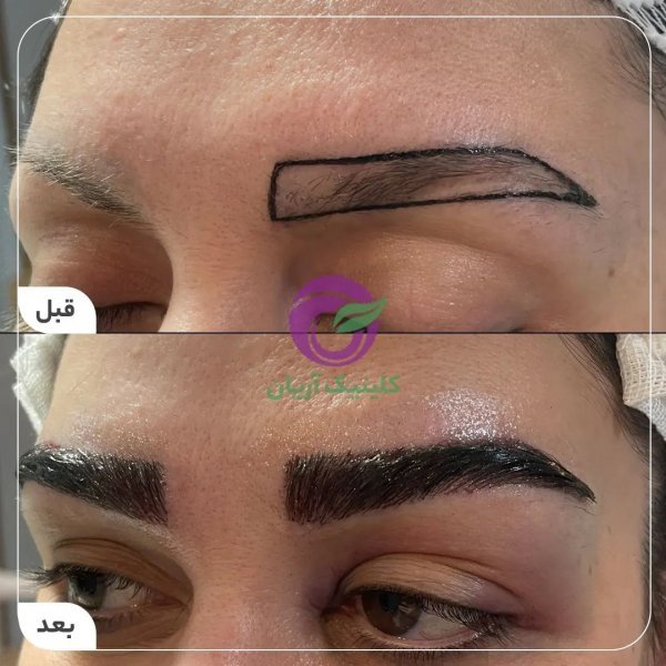  چرا بعد از کاشت ابرو نباید رابطه جنسی سکس داشت