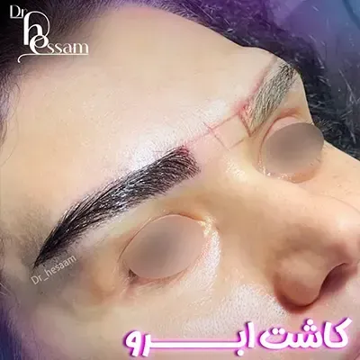  چرا بعد از کاشت ابرو نباید رابطه جنسی سکس داشت