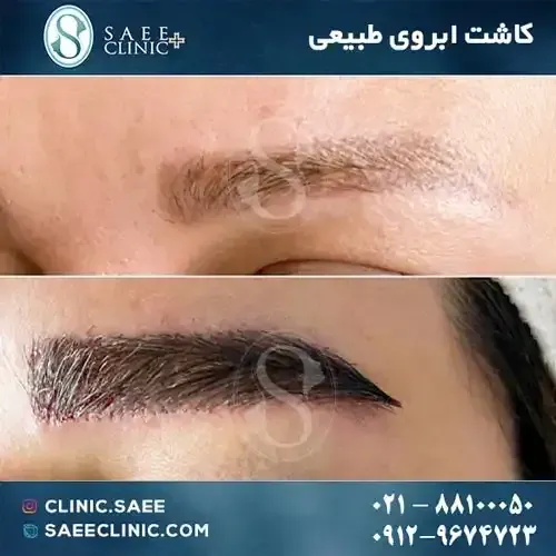  چرا بعد از کاشت ابرو نباید رابطه جنسی سکس داشت