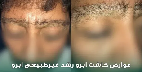  چرا بعد از کاشت ابرو نباید رابطه جنسی سکس داشت