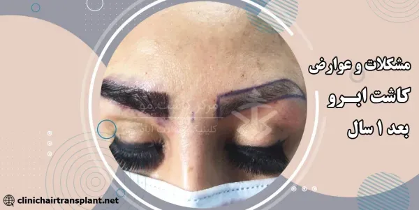  چرا بعد از کاشت ابرو نباید رابطه جنسی سکس داشت