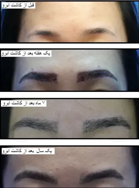  چه مدت بعد از کاشت ابرو ریزش شروع می‌شود
