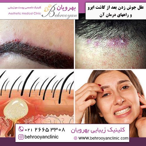  چه مدت بعد از کاشت ابرو ریزش شروع می‌شود