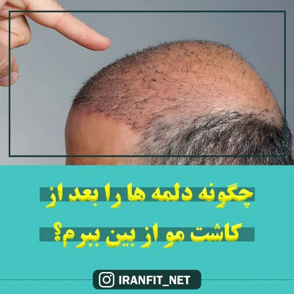 فیلم و عکس کندن دلمه های کاشت مو