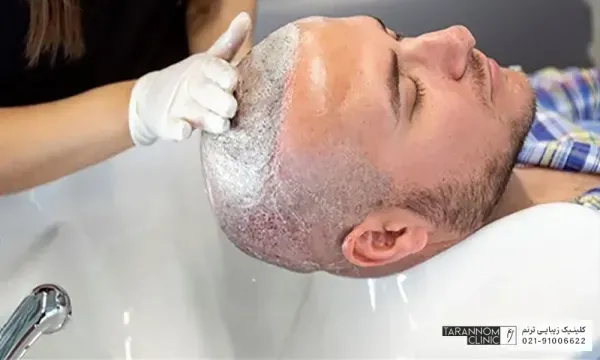  فیلم و عکس کندن دلمه های کاشت مو