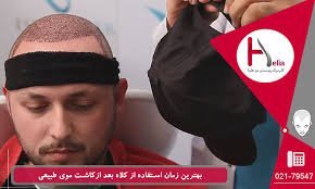  فیلم و عکس کندن دلمه های کاشت مو