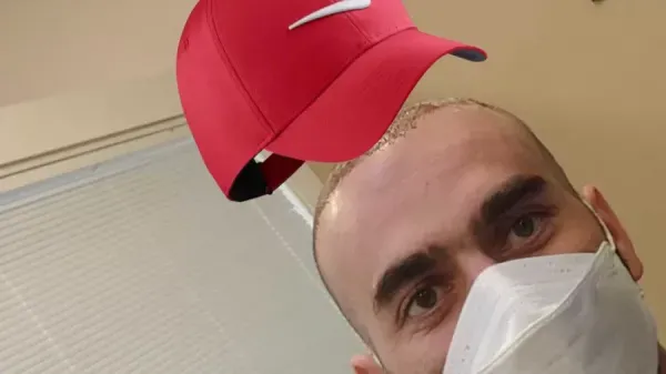  فیلم و عکس کندن دلمه های کاشت مو