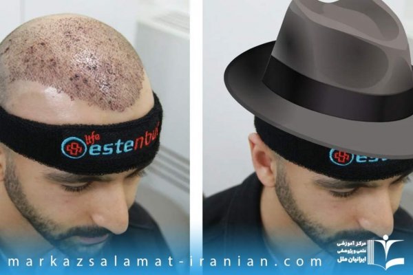  فیلم و عکس کندن دلمه های کاشت مو