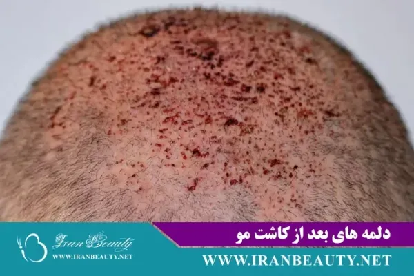  فیلم و عکس کندن دلمه های کاشت مو