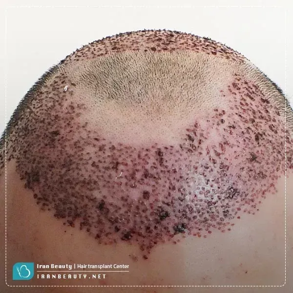  فیلم و عکس کندن دلمه های کاشت مو