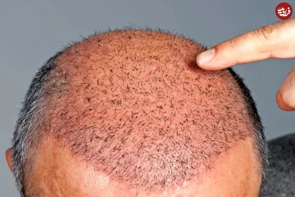  فیلم و عکس کندن دلمه های کاشت مو