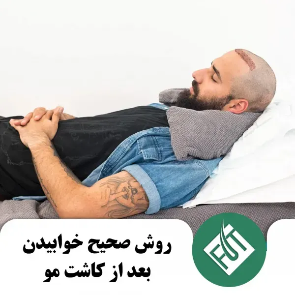  فیلم و عکس کندن دلمه های کاشت مو