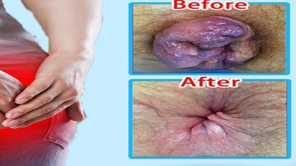  عکس قبل و بعد از عمل بواسیر + بواسیر چیست با عکس