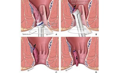  عکس قبل و بعد از عمل بواسیر + بواسیر چیست با عکس