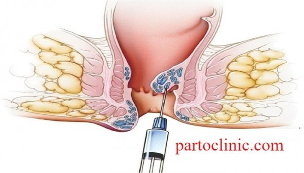  عکس قبل و بعد از عمل بواسیر + بواسیر چیست با عکس