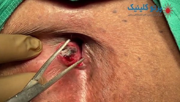  عکس قبل و بعد از عمل بواسیر + بواسیر چیست با عکس