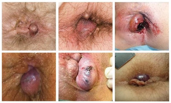  عکس قبل و بعد از عمل بواسیر + بواسیر چیست با عکس