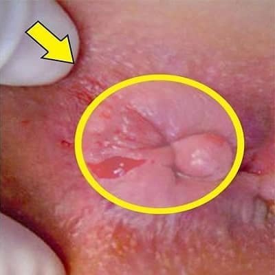  عکس قبل و بعد از عمل بواسیر + بواسیر چیست با عکس