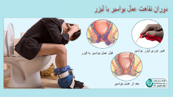  عکس قبل و بعد از عمل بواسیر + بواسیر چیست با عکس