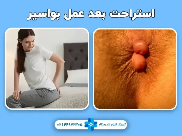  عکس قبل و بعد از عمل بواسیر + بواسیر چیست با عکس