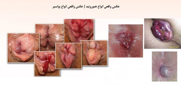  عکس قبل و بعد از عمل بواسیر + بواسیر چیست با عکس