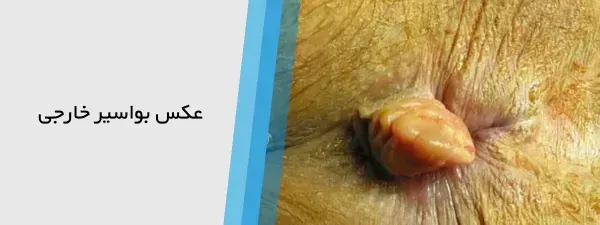  عکس قبل و بعد از عمل بواسیر + بواسیر چیست با عکس