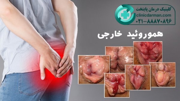 عکس قبل و بعد از عمل بواسیر + بواسیر چیست با عکس
