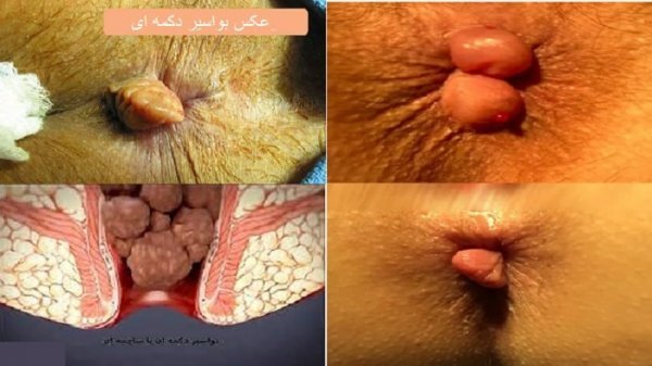  عکس قبل و بعد از عمل بواسیر + بواسیر چیست با عکس