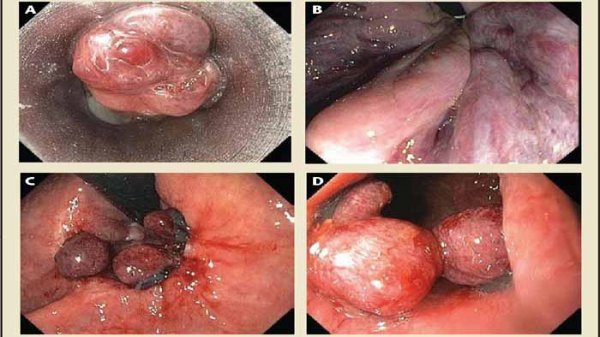  عکس قبل و بعد از عمل بواسیر + بواسیر چیست با عکس