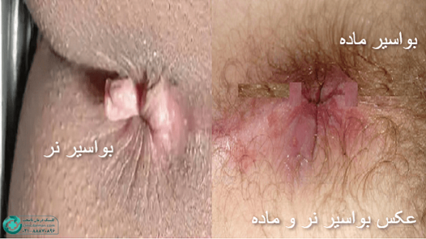  عکس قبل و بعد از عمل بواسیر + بواسیر چیست با عکس